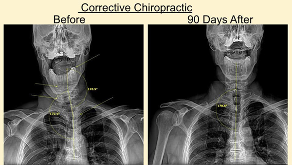 Chiropractic Adjustment Before And After